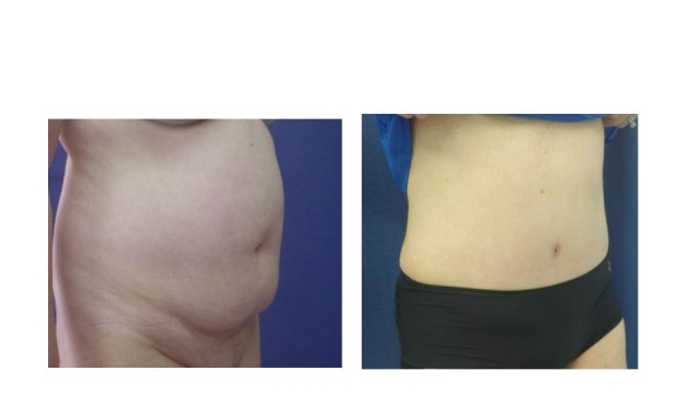 Flatten Your Tummy Permanently: All About Abdominoplasty