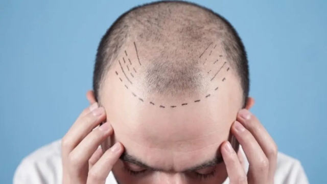 From Bald to Bold: The Ultimate Guide to Hair Transplants