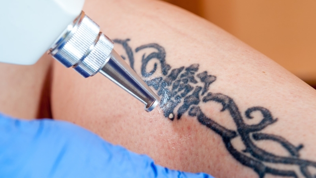 Different Tattoo Removal Methods